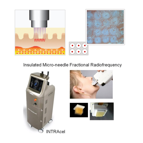 Fractional RF Treatment